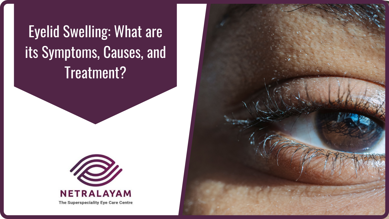Eyelid Swelling What Are Its Symptoms Causes And Treatment