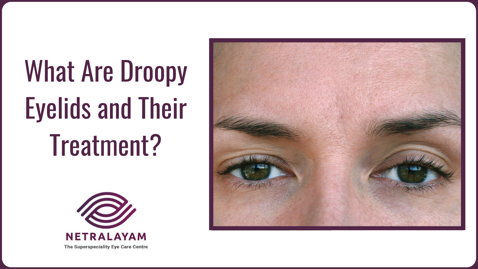 What Are Droopy Eyelids And Their Treatment 